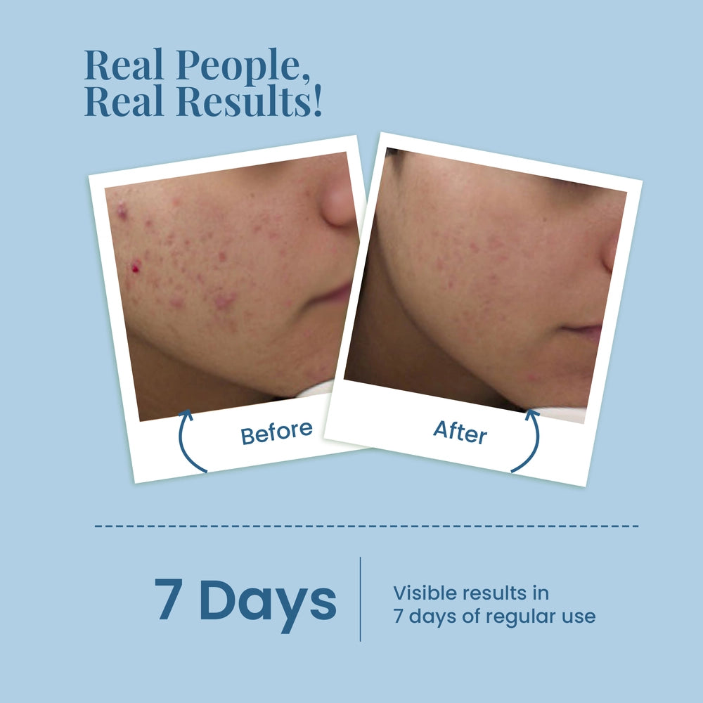 Ultimate Solution for Clear, Poreless Skin - La Pink Acne & Pore Face Wash