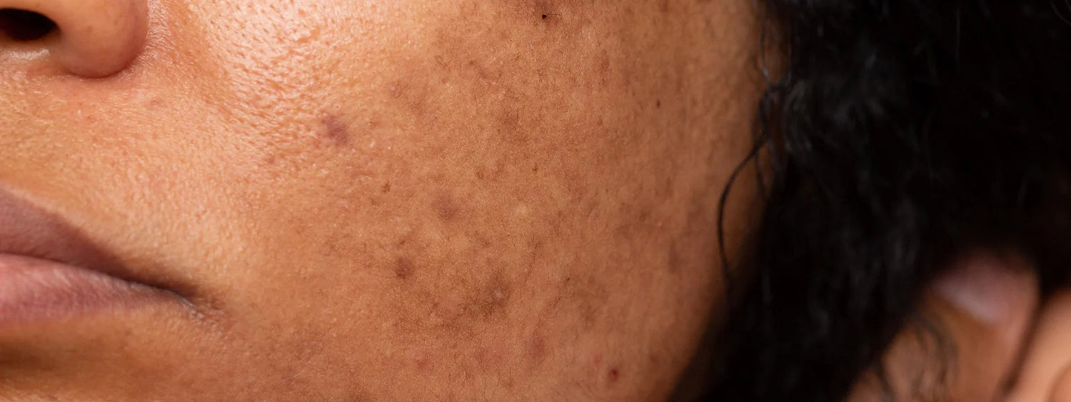 Face Dark Spots Pigmentation Concern