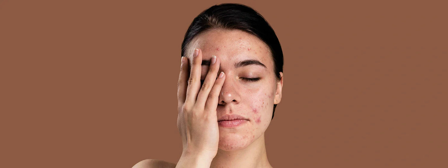 Face Acne Pore Perfection Concern